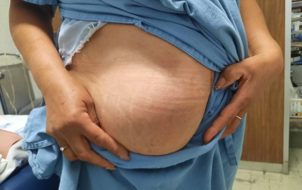 Cirugía de hernias y pared abdominal en edo de mex